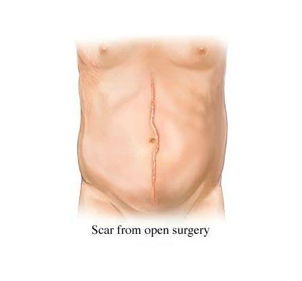 A man's stomach with a scar from open surgery. Visit the top hospital in Kota for excellent laparoscopic surgery.