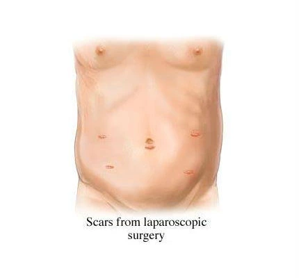 Scars from laparoscopic surgery at the top-rated hospital in Kota, known for its excellence in surgical procedures.