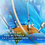 Why go for Multiple – Cut Laparoscopic Surgery?